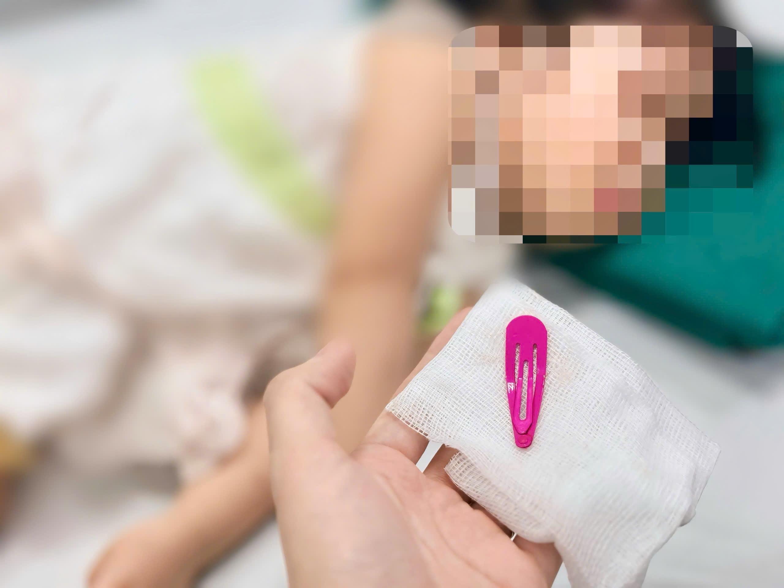 Be 21 thang tuoi phai nhap vien vi kep toc nam trong da day hinh anh