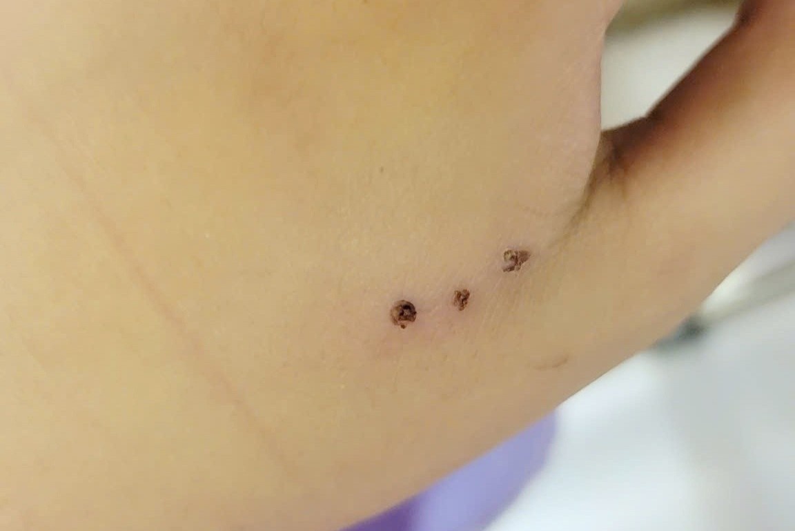 Be 10 tuoi nhap vien vi bi chuot can hinh anh