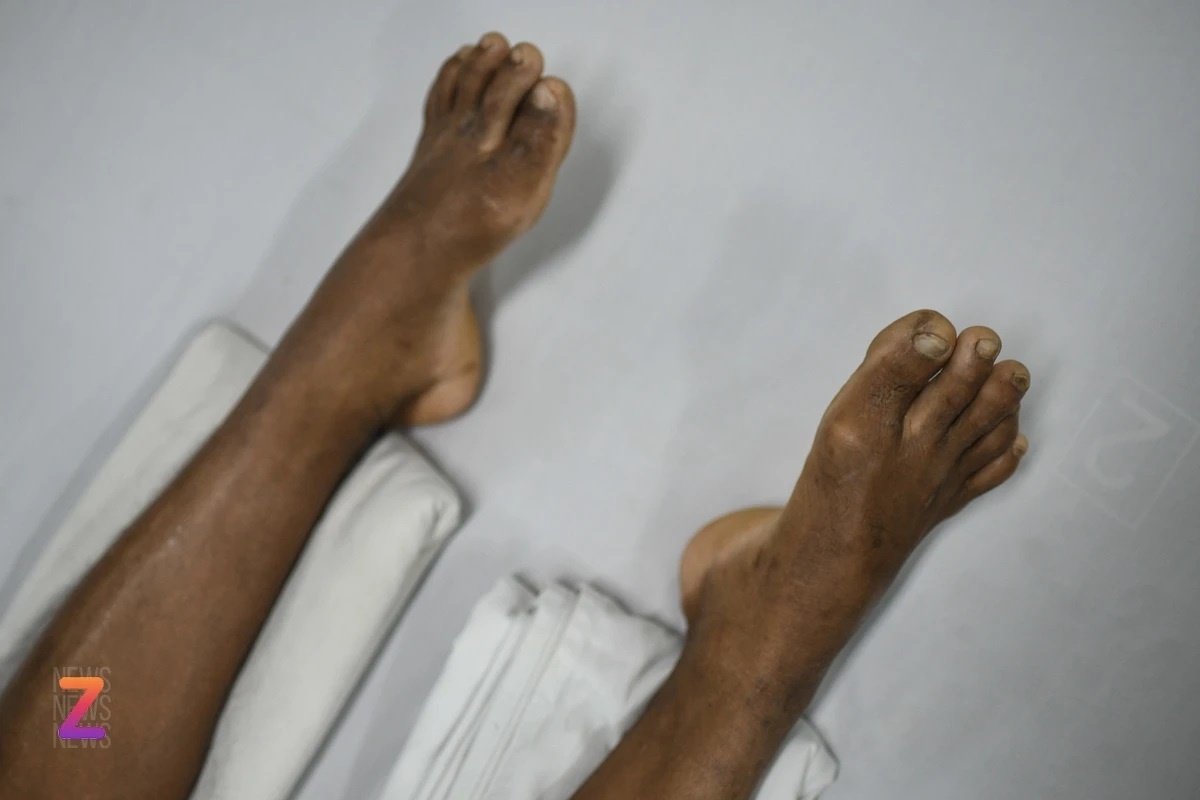 Can benh tu vet tray xuoc nho co the cuop di mang song hinh anh