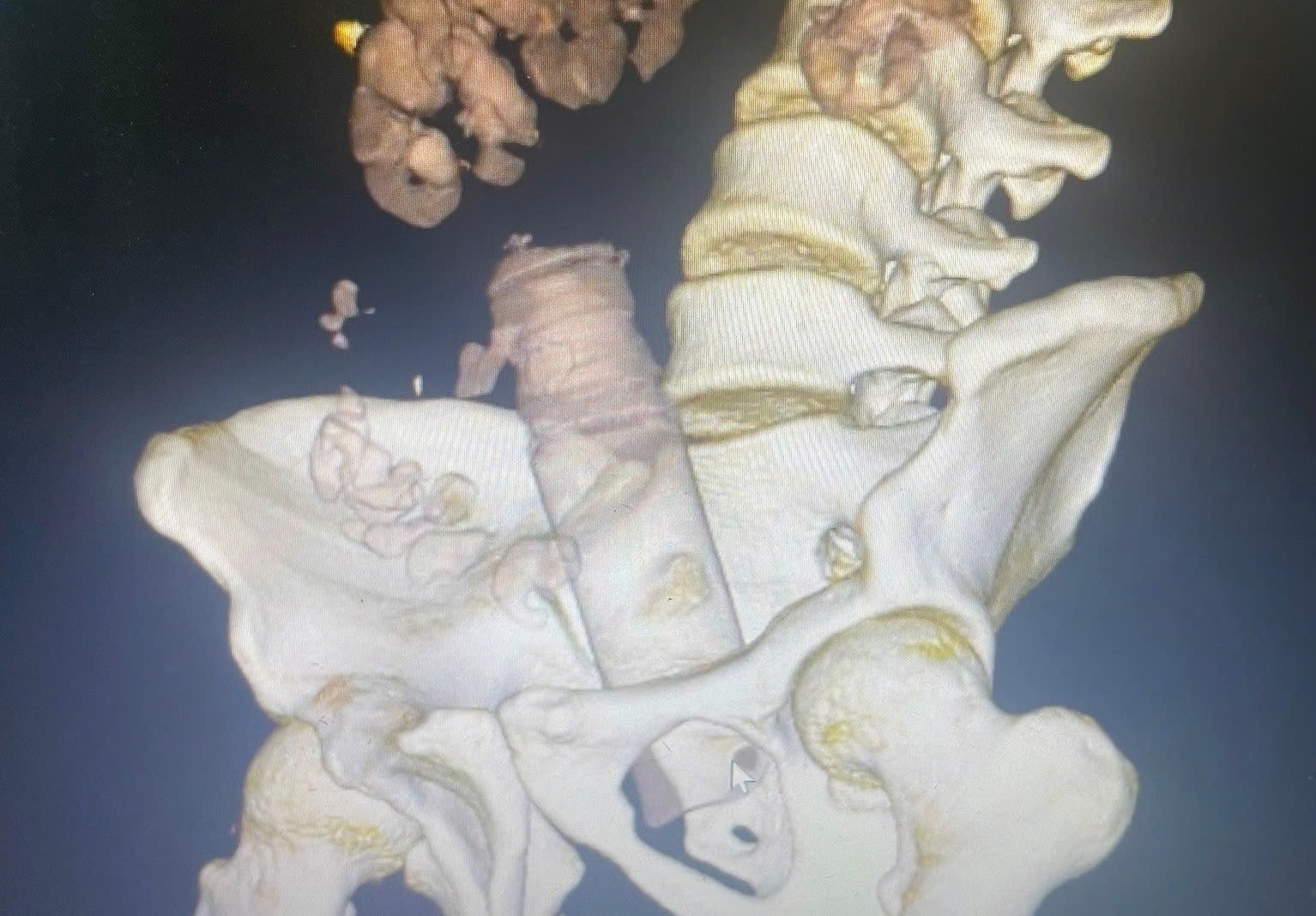 Tu che do choi tinh duc, nam thanh nien nhap vien vi di vat 'mac ket' hinh anh