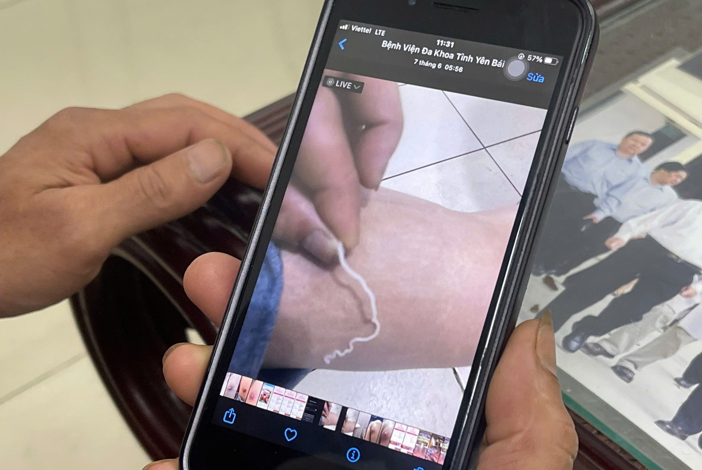 Them mot ca benh giun rong tai Viet Nam hinh anh