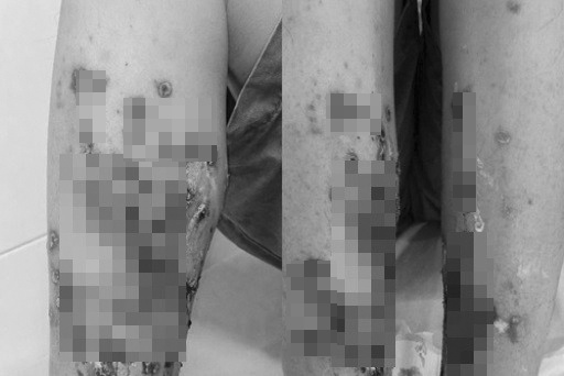 Loi nuoc ban, nguoi dan ong phai nhap vien vi viem da lan rong hinh anh