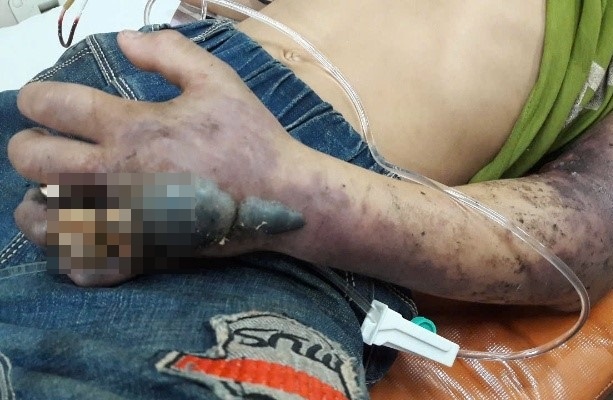 Quyet dinh sai khien nan nhan bi ran can ngung tim, ton thuong nao hinh anh