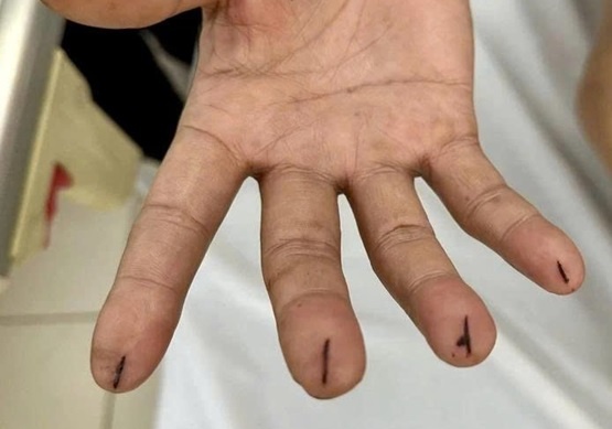 Chich mau chua dot quy: Bac si noi gi? hinh anh