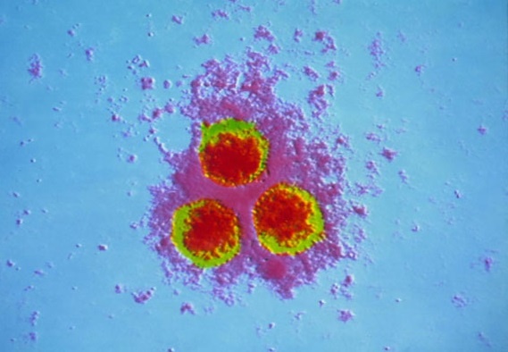 Mot loai virus 'ngu quen' bong tai phat gay liet mat hinh anh