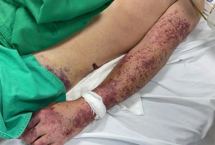 Sau vai ngay sot cao, nguoi dan ong o Ha Noi khong qua khoi hinh anh