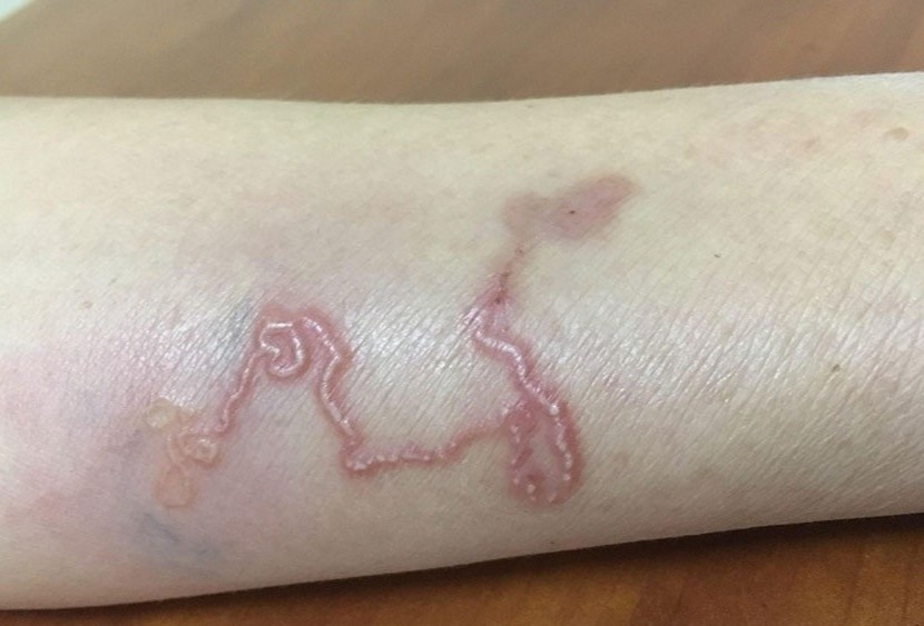 Mon khoai khau khien nguoi dan ong nhiem ca 2 loai ky sinh trung hinh anh