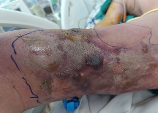 Vet dot nho khien chuyen tam bien thanh con bao benh hinh anh