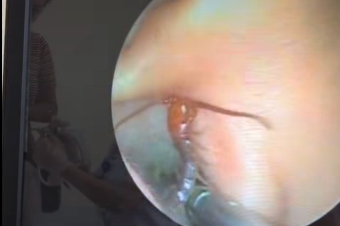 Bac si soc khi vo tinh phat hien con ret song trong tai be trai hinh anh