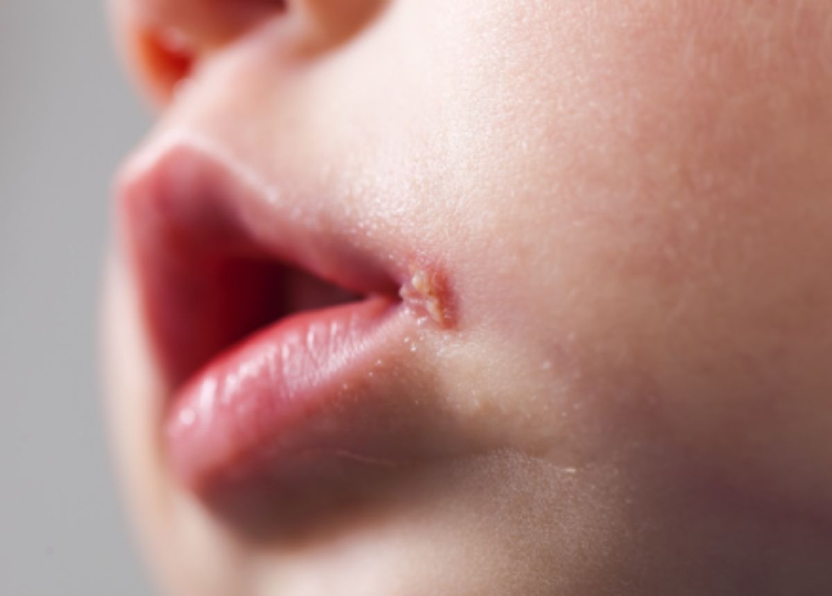 Nhiem HSV o tre so sinh hinh anh