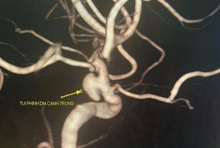 Dau dau, run tay thoang qua, co gai tre phat hien 'bom no cham' o nao hinh anh