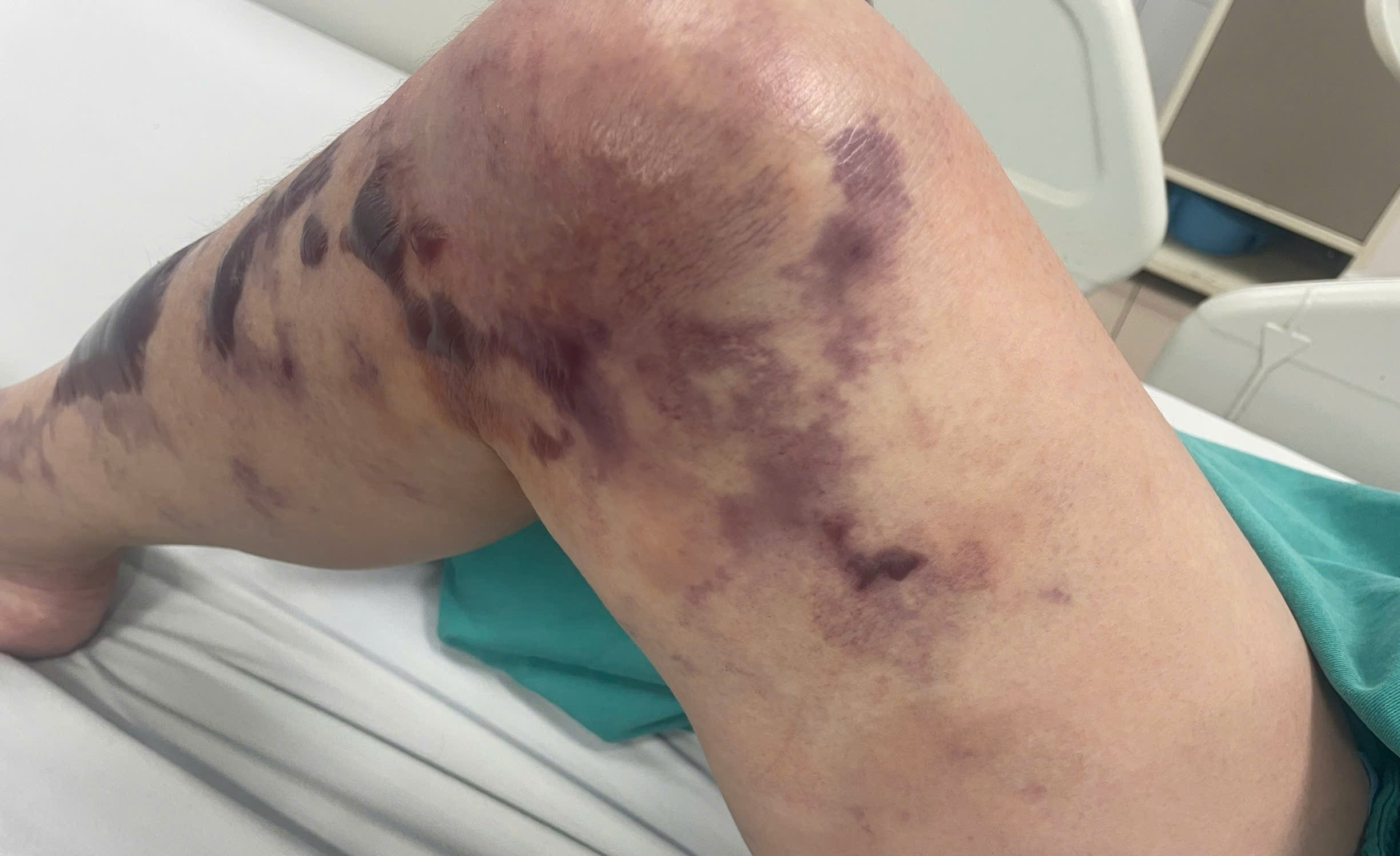 Vet xuoc tuong chung vo hai hoa thanh con bao benh hinh anh