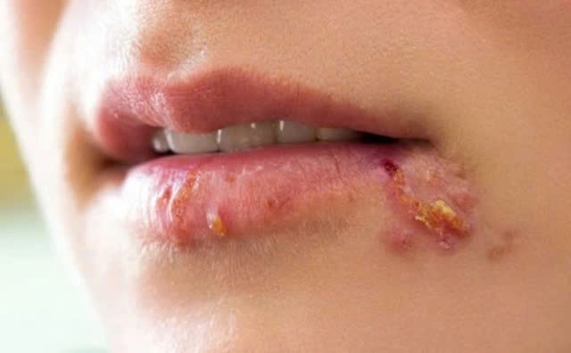 Vi sao zona thuong tai phat va gay dau keo dai? hinh anh