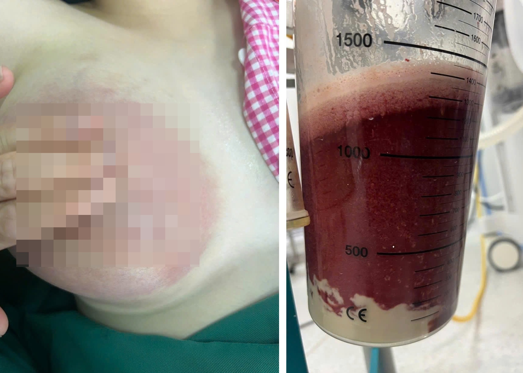 Me tre bi ap xe nguc vi mot so suat khi cho con bu hinh anh