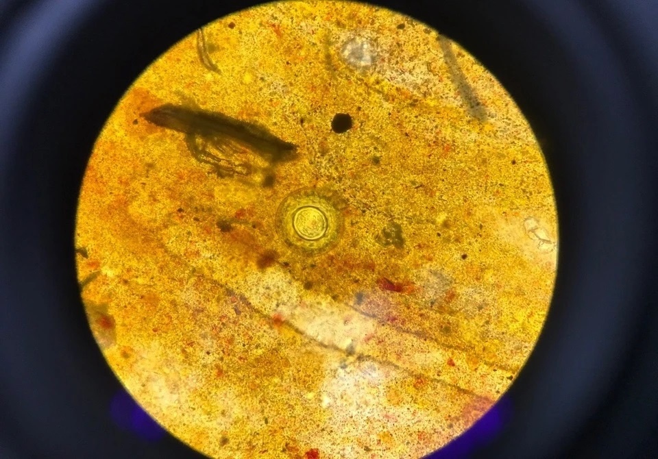 Trieu chung mo ho de bi bo qua cua benh san day nho hinh anh