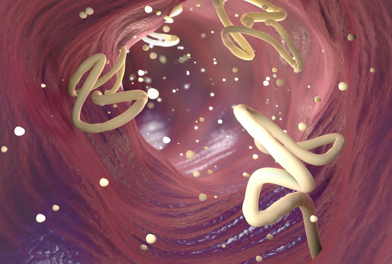 Nguy co san vao nao tu thoi quen an uong, bac si chi cach phong tranh hinh anh