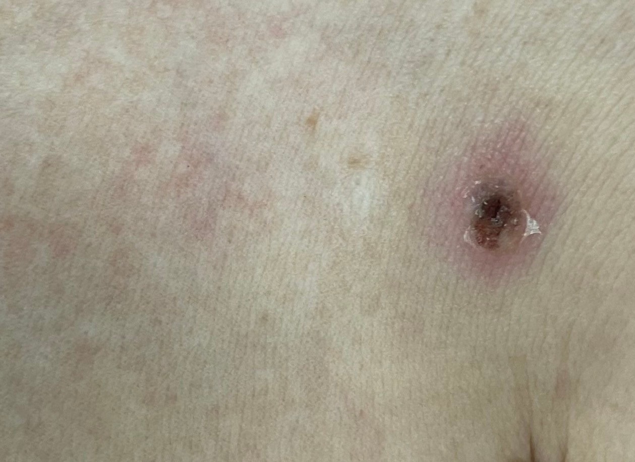 Dung coi thuong vet loet tron mau den o cac hom co the hinh anh