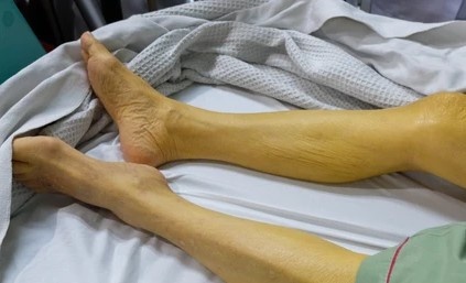 Loat nguyen nhan khien nguoi Viet mac ung thu gan nhieu hon hinh anh