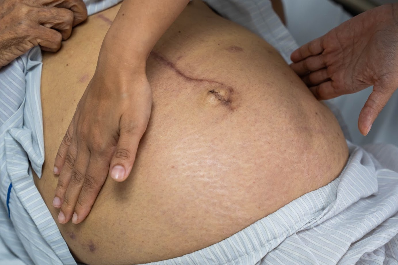 Trieu chung ton thuong gan, viem gan B giai doan dau hinh anh