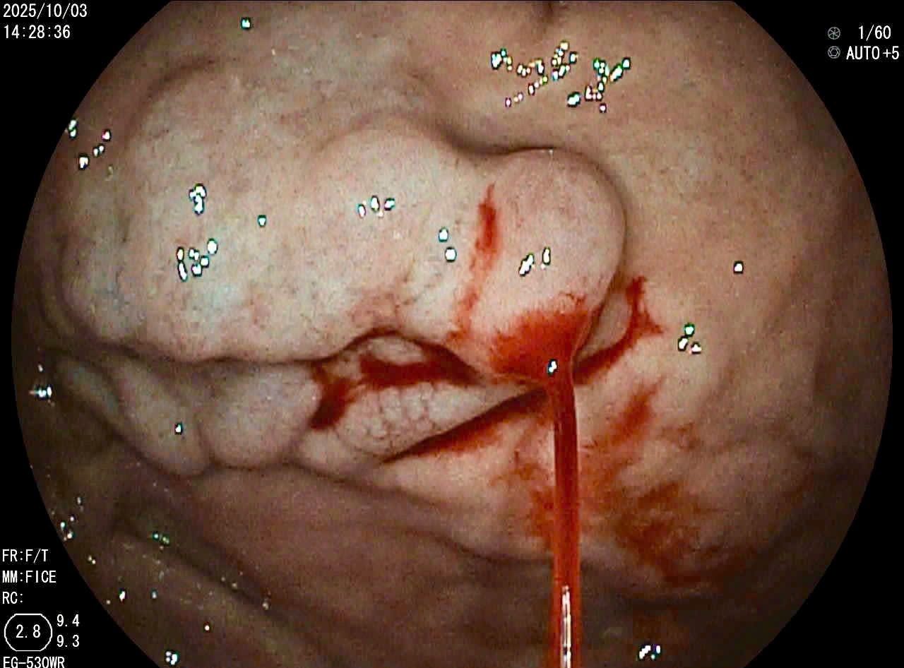 Nguoi dan ong di tieu phan den, mau phun thanh tia trong da day hinh anh