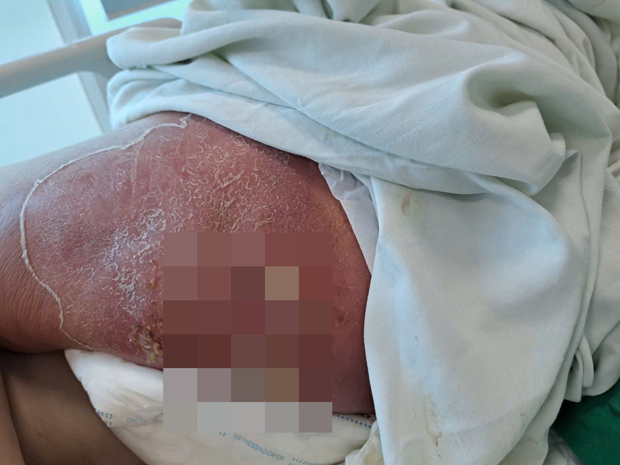 Vet mun tuong nho o mong bien thanh con bao benh hinh anh