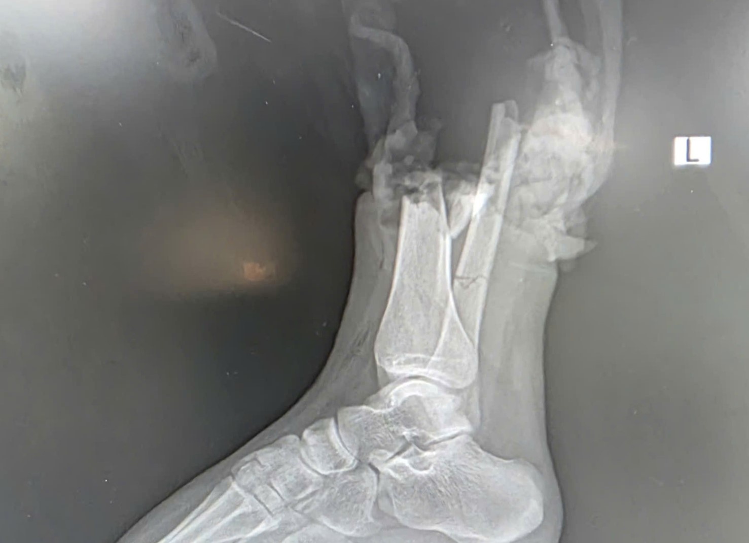 Va cham mo to phan khoi lon, nu sinh 19 tuoi dut lia chan hinh anh