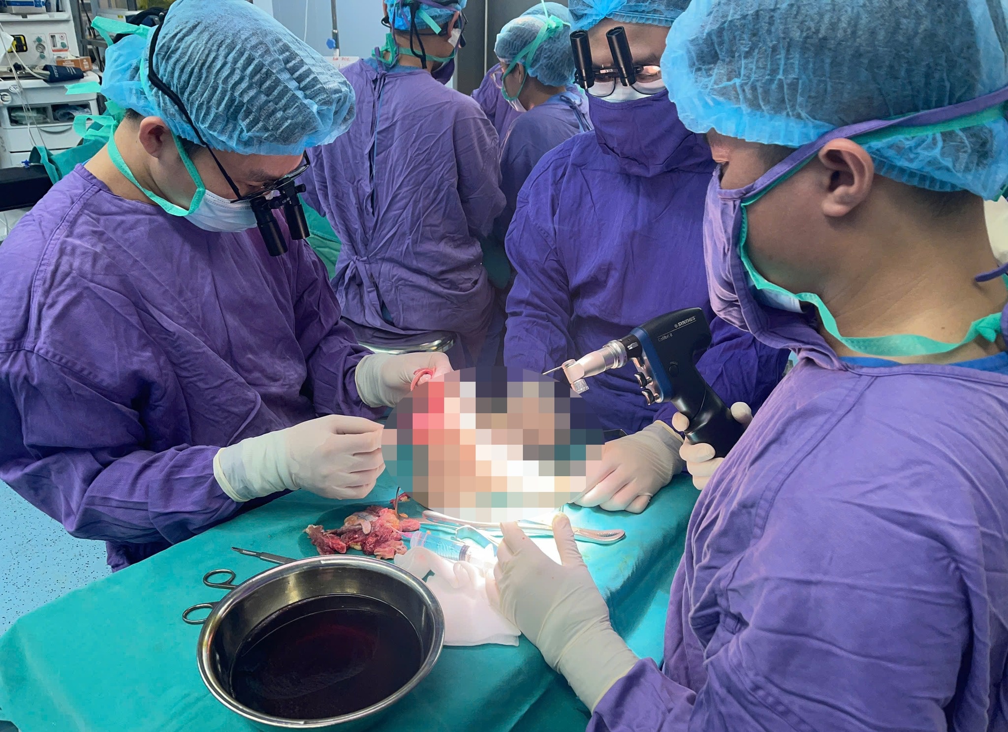 chân đứt rời  ảnh 1 chan dut roi anh 1