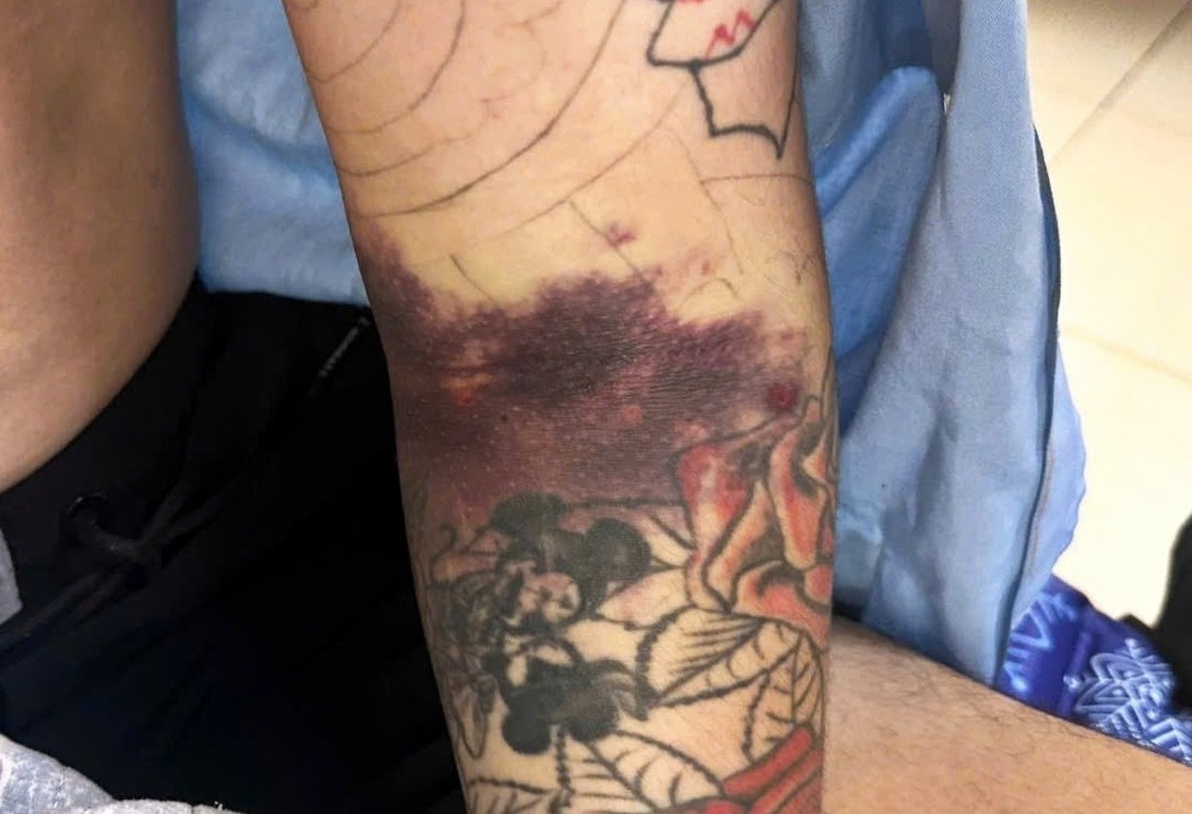 Suyt mat canh tay vi bien chung nguy hiem sau khi bi muoi dot hinh anh