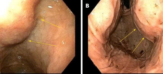 Ung thu gan phat trien than toc sau 1 nam phat hien bi viem gan B hinh anh