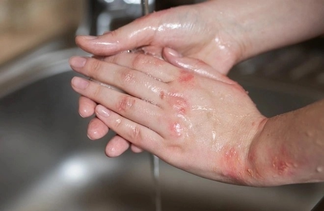 Sinh vat sieu nho gay nen con ngua du doi ban dem hinh anh