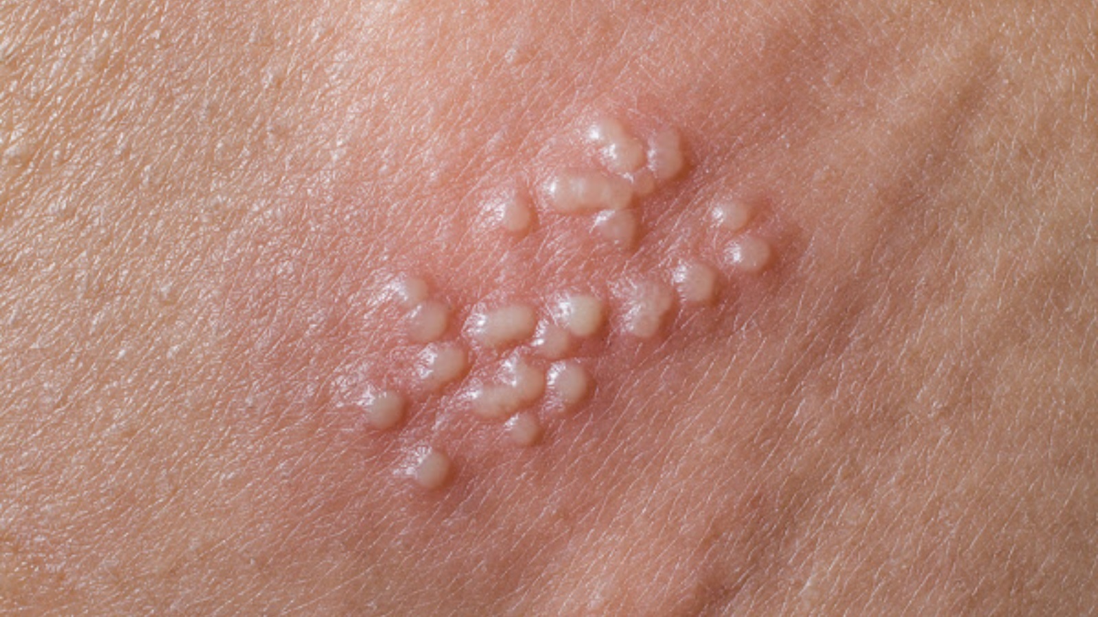 Nguyen nhan gay benh mun rop sinh duc hinh anh