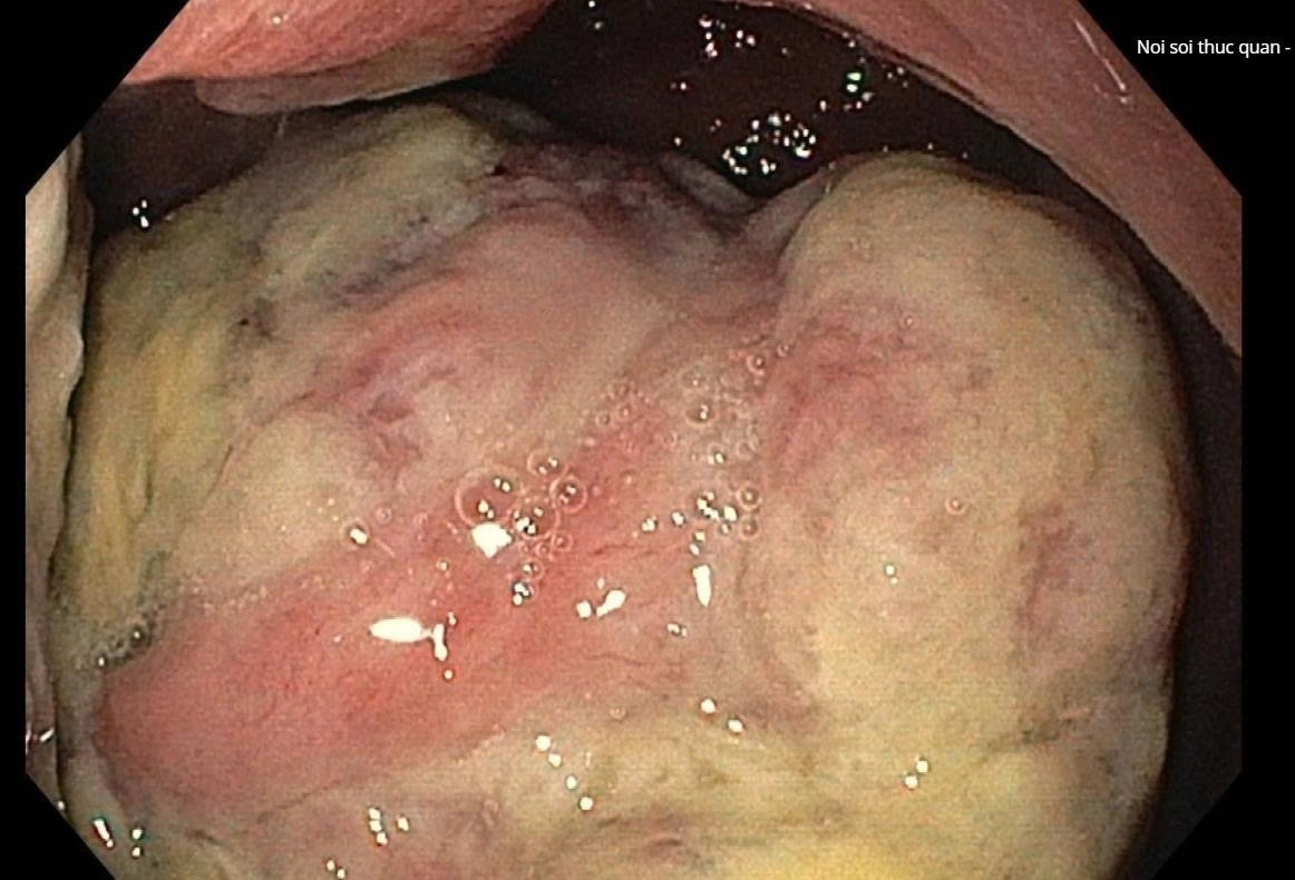 Hai trieu chung la giup nguoi dan ong phat hien mac ung thu hinh anh