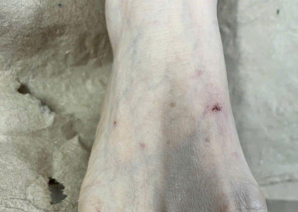 Ganh hau qua vi nan mau, thoa nuoc chanh len vet meo can hinh anh