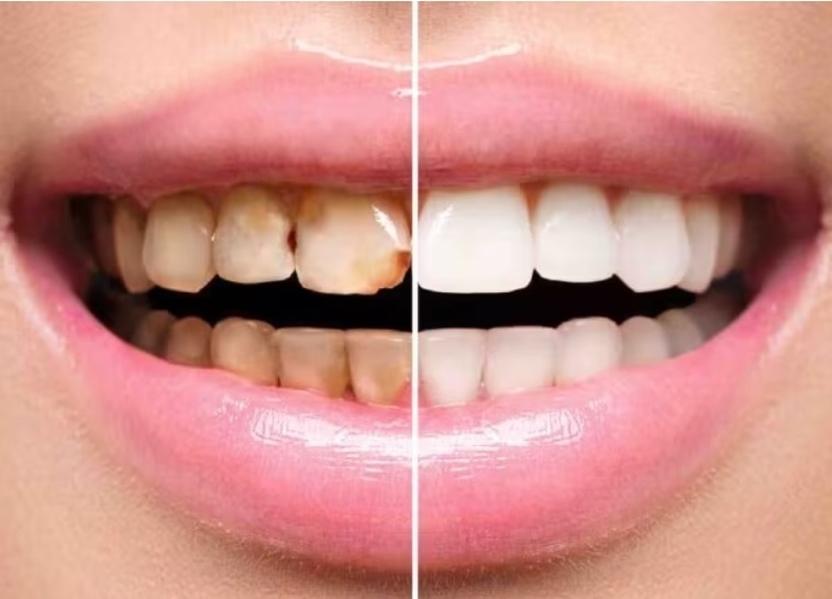 Khi nao khong nen lay cao rang? hinh anh