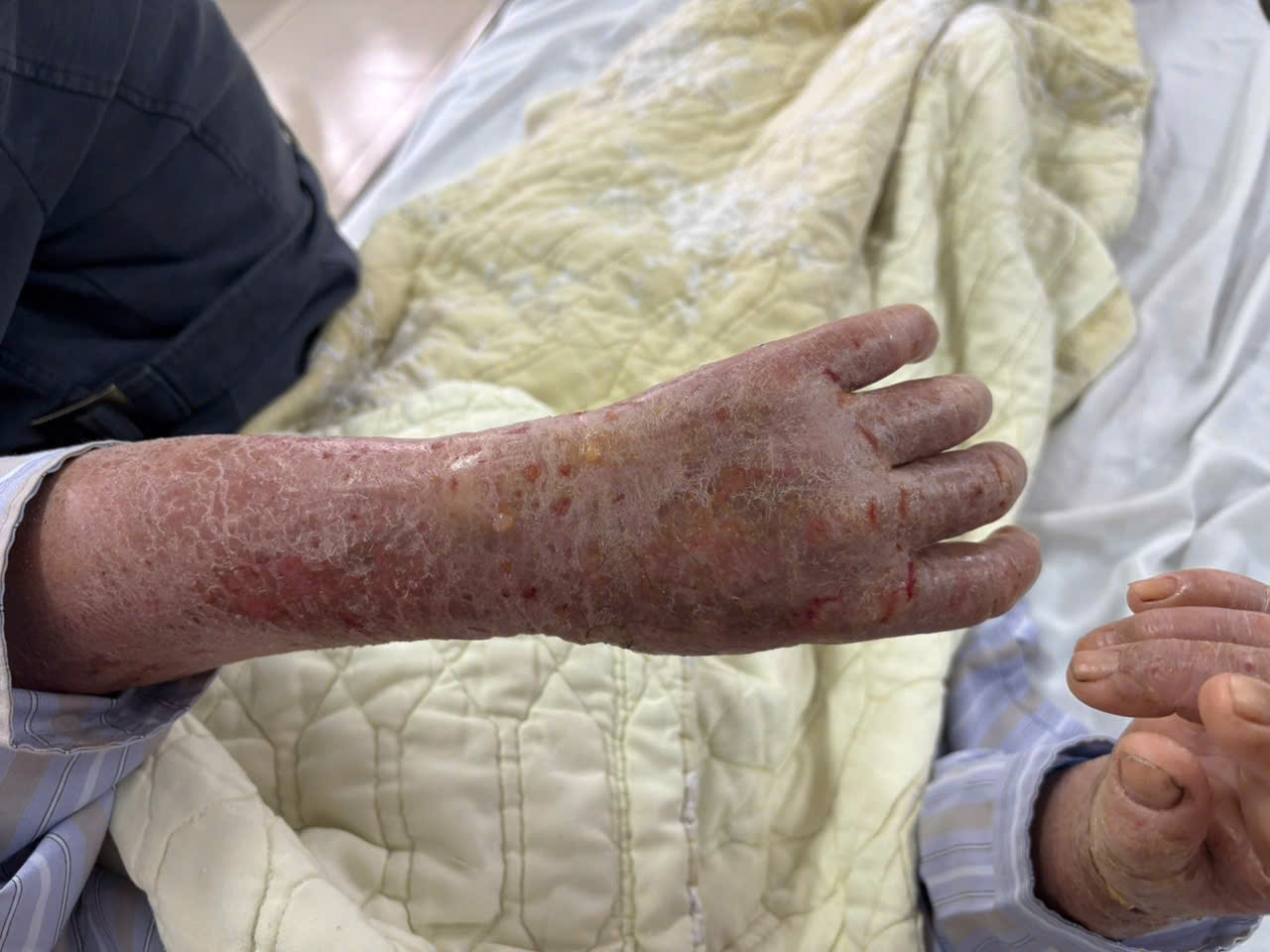 Benh nhan bi nut toac da, ngua ngay nhu co sau bo hinh anh