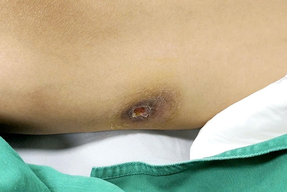 Mot vet tray nho, benh nhan bi Whitmore tan cong toan co the hinh anh