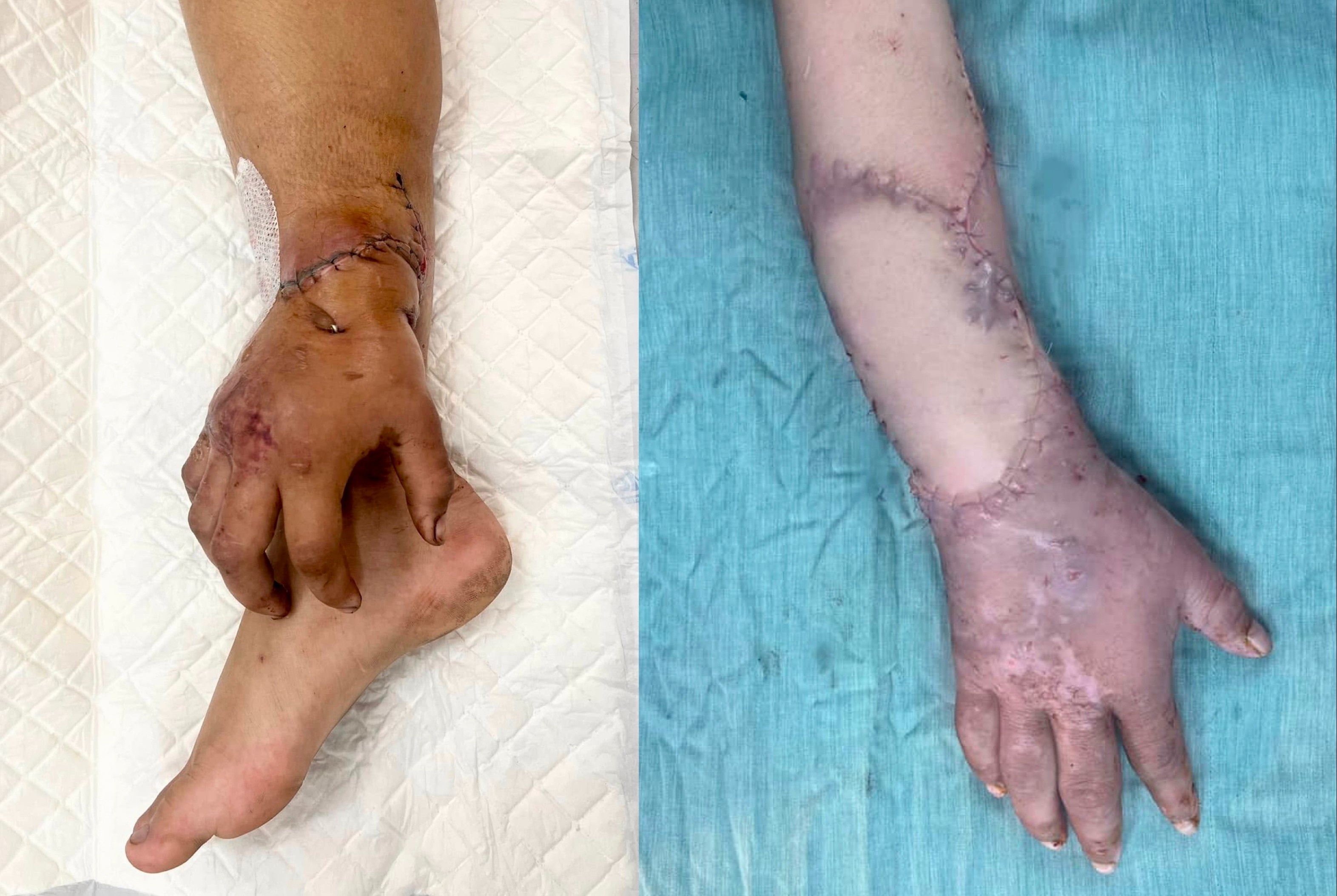 Noi lai ban tay cho san phu, sau 2 thang duoc ghep tam vao chan hinh anh