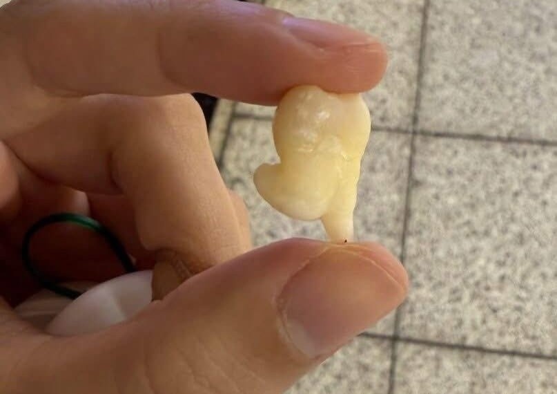 Rang khon 'nhay chan sao' gay sot MXH: Bac si giai thich khi nao nho hinh anh