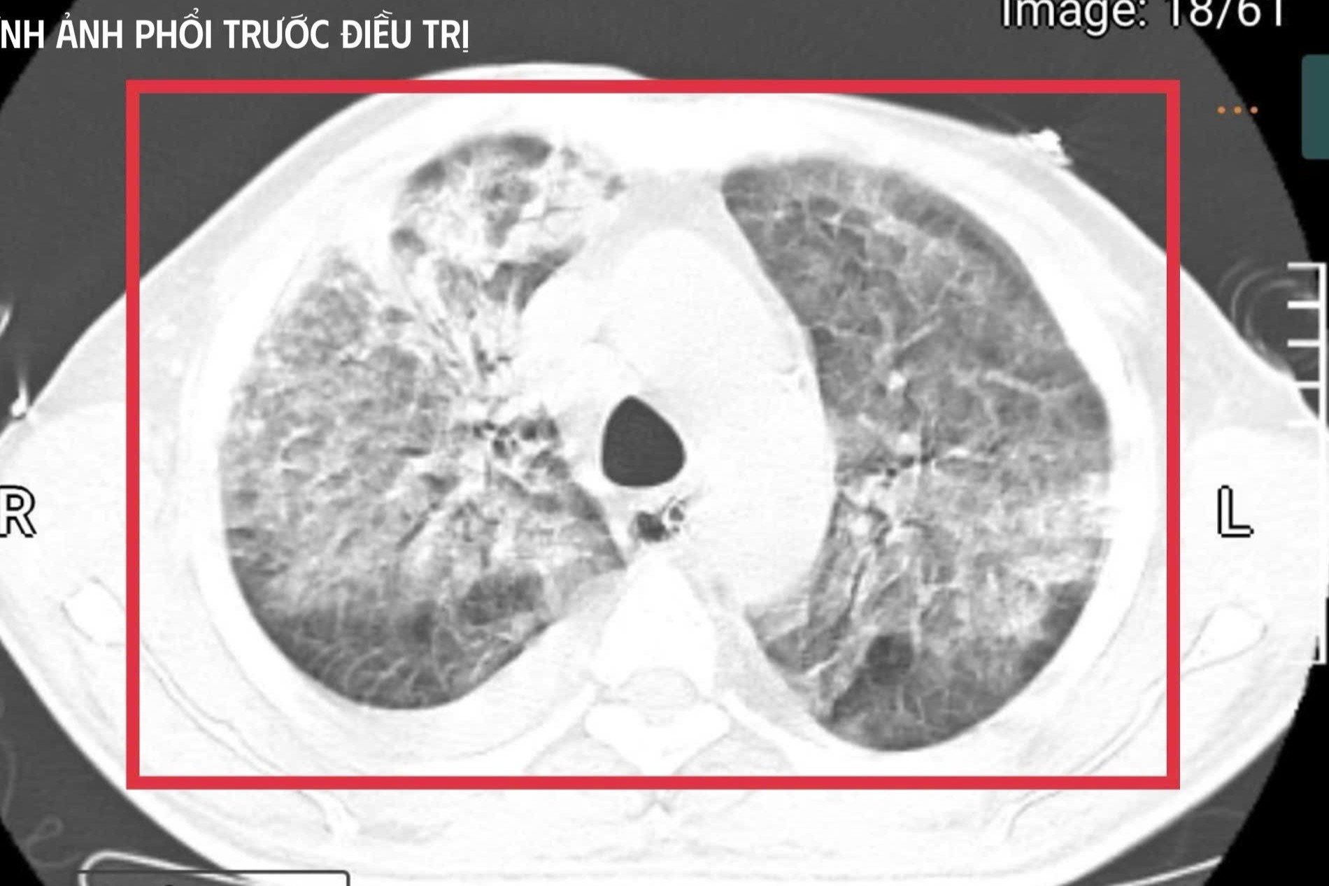 Nguoi dan ong tro ve tu Thai Lan, mang theo vi khuan 'tu than' hinh anh