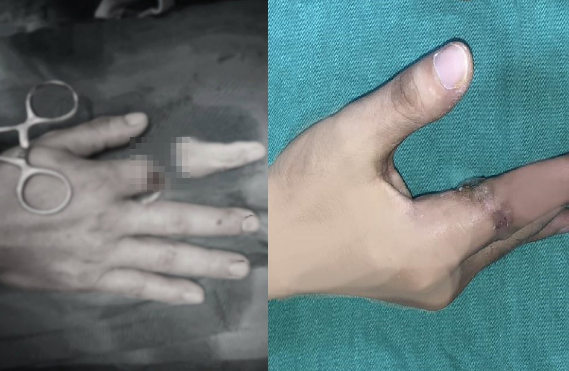 Nguoi dan ong nhap vien voi ngon tay dut lia bo trong binh giu nhiet hinh anh