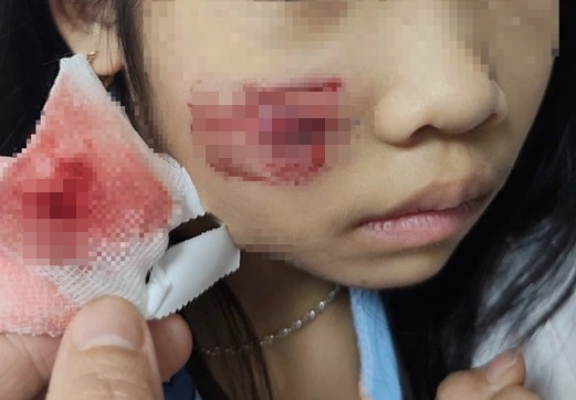 Chau be bi khi tan cong gay vet thuong phuc tap vung mat, dau hinh anh