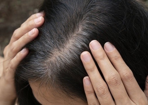 Toc bac nhieu la dau hieu ung thu: Bac si noi gi? hinh anh