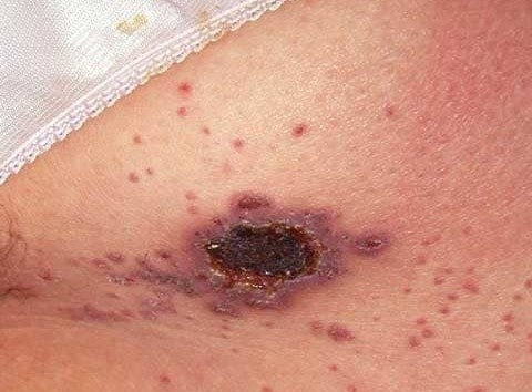 Nhung ca phat hien HIV khien bac si 'giat minh' hinh anh