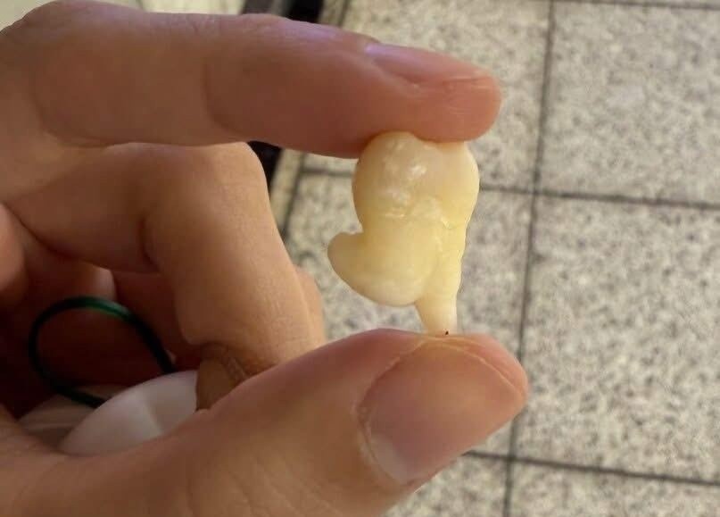 Rang khon co nhat thiet phai nho khong? hinh anh