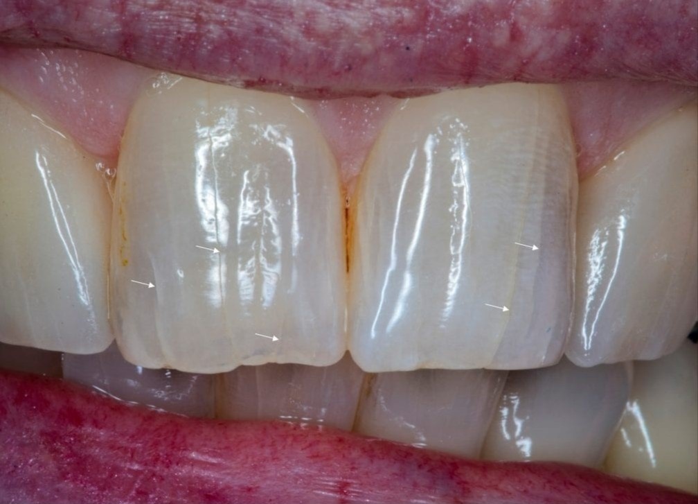 Tuong vo hai, cac vet ran tren rang co the gay rac roi lon hinh anh