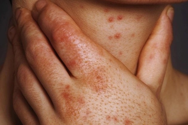 HIV, giang mai phuc tap tai Viet Nam, bac si chi ra nguyen do hinh anh