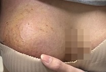 Nguoi phu nu nhap vien voi vung nguc day mu, bien dang hinh anh