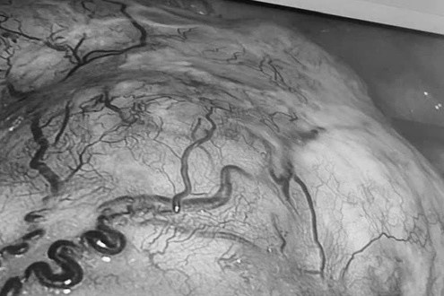 Mot benh nhan cung luc phat hien mac 2 khoi u ac tinh hinh anh