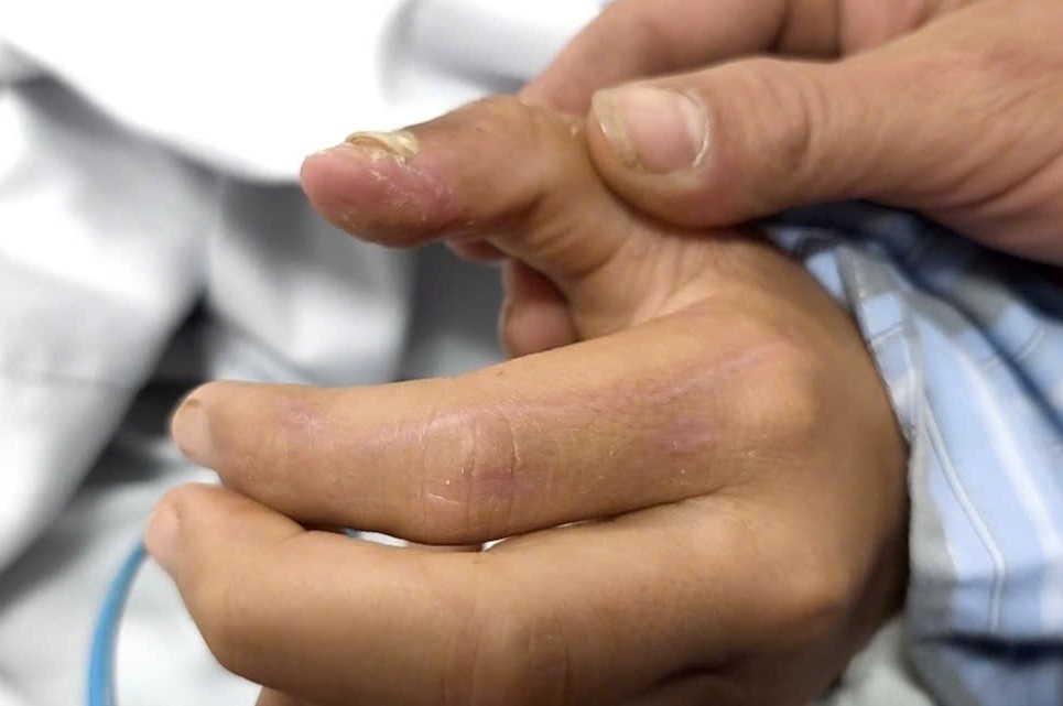 Vet cho can da lanh, be trai 14 tuoi van mac benh dai hinh anh