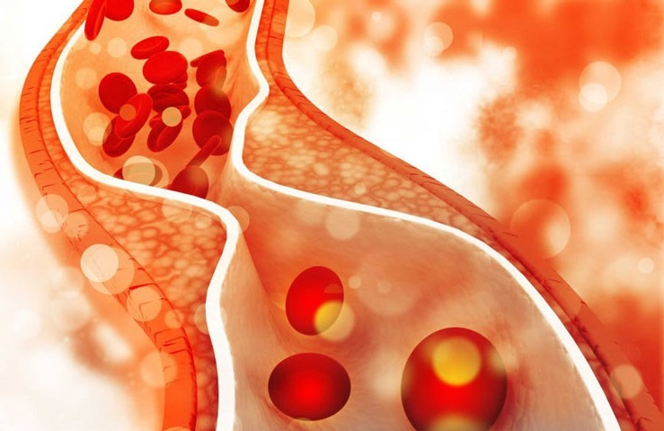 Dau hieu khi tang triglycerid mau hinh anh